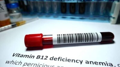 &nbsp; Evet, B12 vitamini siyatik ağrısına neden olabilir. Ayrıca bacaklarda