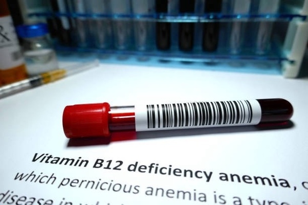 &nbsp; Evet, B12 vitamini siyatik ağrısına neden olabilir. Ayrıca bacaklarda