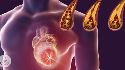 Ateroskleroz veya tıkanmış arterler, arter duvarları boyunca yağ birikintilerinin oluşmasıyla