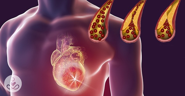 Ateroskleroz veya tıkanmış arterler, arter duvarları boyunca yağ birikintilerinin oluşmasıyla